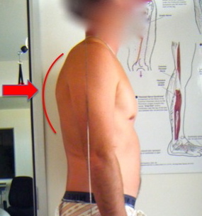 Thoracic Kyphosis: The "Hunch-back" Posture - endyourbackpainnow.com